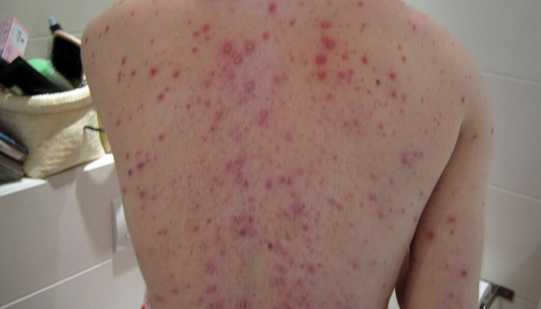 Varicella Negli Adulti Quali Sono I Sintomi