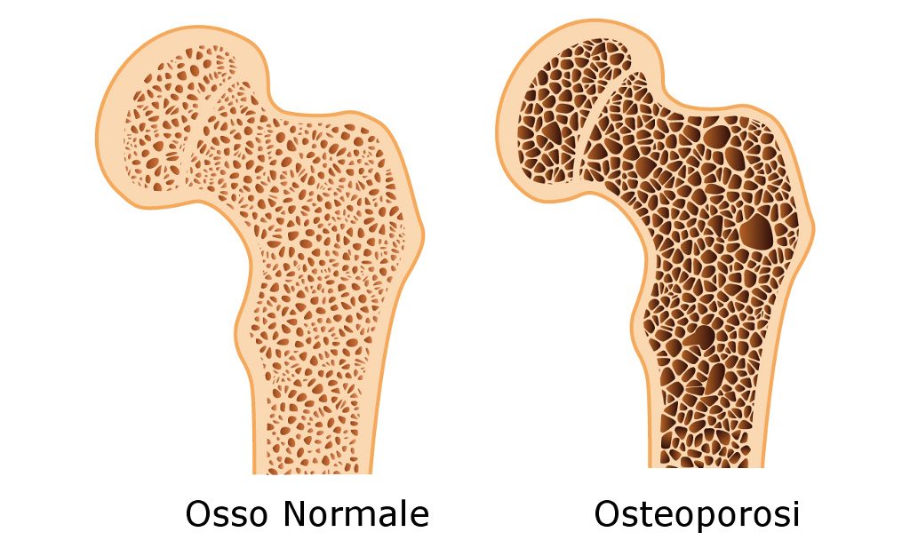 Osteoporosi Sintomi Cause Complicazioni E Diagnosi