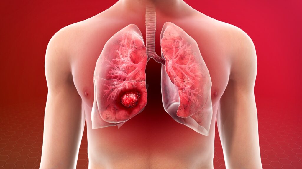 Cancro al polmone: i segnali d’allarme da non ignorare