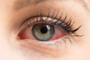 Occhi secchi: attenzione alle allergie stagionali