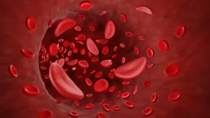 Che cos’è l’anemia falciforme? Quello che devi sapere