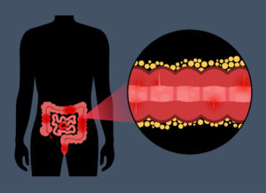 Vivere con la malattia di Crohn: cause, sintomi e consigli