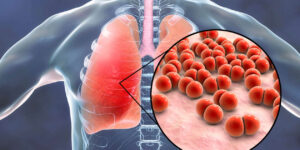 Quali sono i campanelli d’allarme della polmonite da Pneumococco?